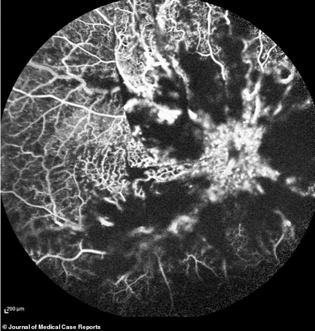 This scan shows the damage caused by blocked blood vessels in the 32-year-old man's right eye.