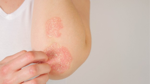 UCB Obtains FDA Approval for Treatment of Plaque Psoriasis After Regulatory Setbacks |  BioSpace