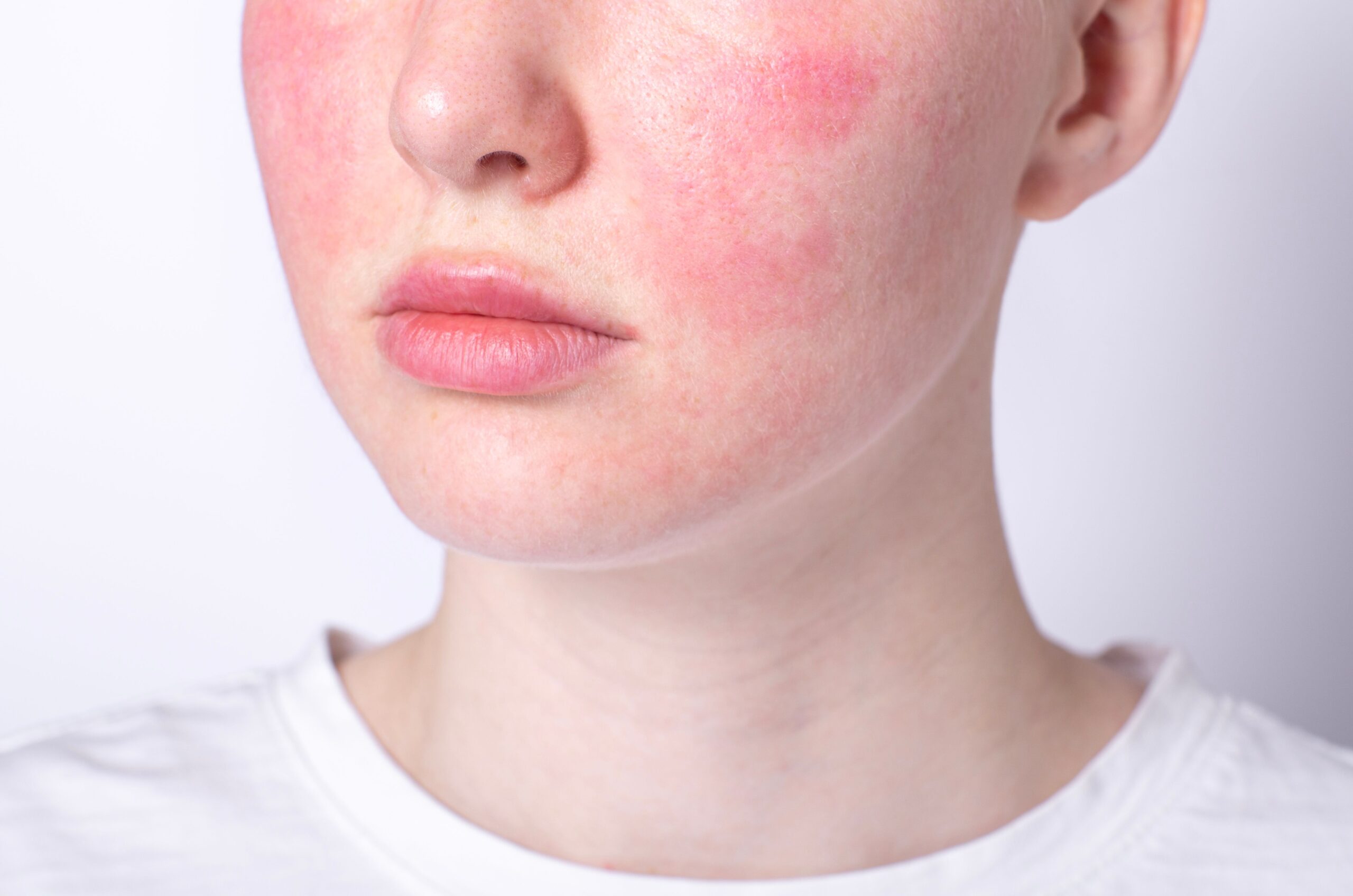 Review finds topical erythromycin, azithromycin and metronidazole the most common treatments for pediatric rosacea